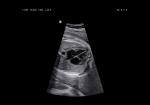 Fetal heart with ClearVision