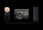 S-Detect™ for Breast