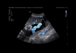 Umbilical cord with MV-Flow™
