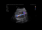 Renal artery (S-Flow™ with LumiFlow™)
